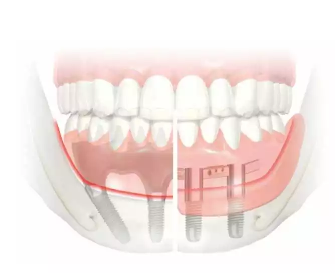 Dental Implants - Implants Cost - Auckland Implant Dentists