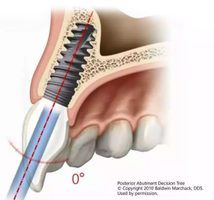 implants_6