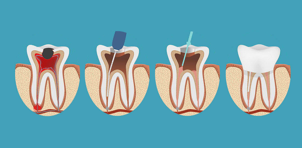 Ds Root Canal Treatment Smile Dental